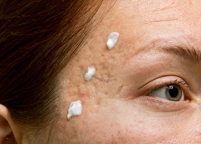 Woman with pockmarks on her eye area from acne with a homemade overnight acne spot treatment on this problem area