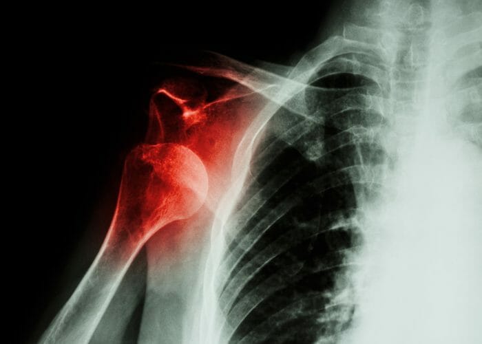 xray of a dislocated shoulder, a common workout injury